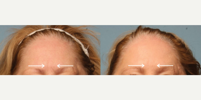 Botox before and after photo