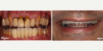 Dental Implants before and after photo