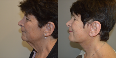 Facelift before and after photo