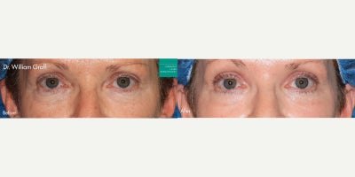 before and after image
