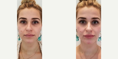 Lip Fillers before and after photo