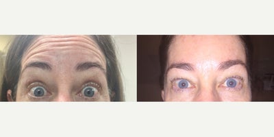 Botox before and after photo