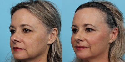 Cheek Fillers before and after photo
