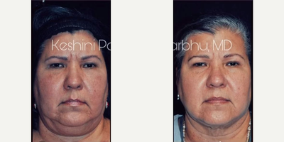 Chin Liposuction before and after photo