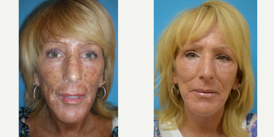 CO2 Laser before and after photo