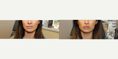 Restylane before and after photo