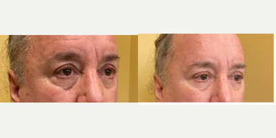 Cheek Augmentation before and after photo