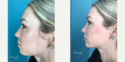 Chin Filler before and after photo