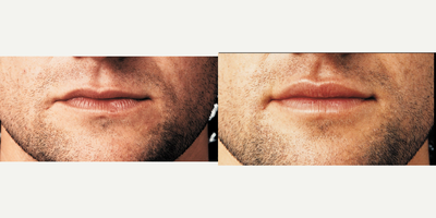 Juvederm before and after photo