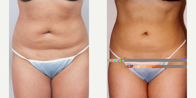 Liposuction before and after photo