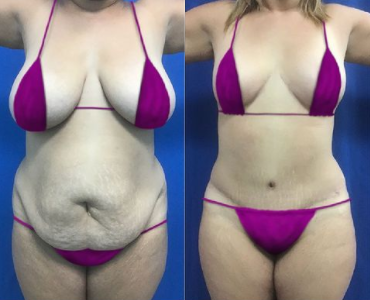 Mommy Makeover before and after photo