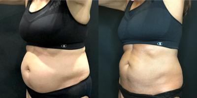 CoolSculpting before and after photo
