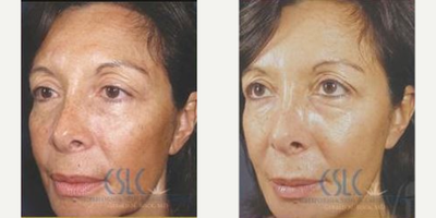 Chemical Peel before and after photo