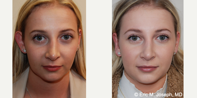 Ear Surgery before and after photo
