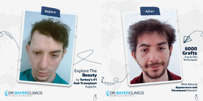 Eyebrow Transplant before and after photo