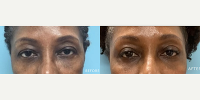 Eyelid Surgery before and after photo