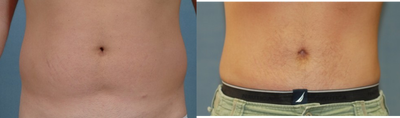 Laser Liposuction before and after photo