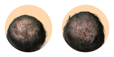 PRP for Hair Loss before and after photo