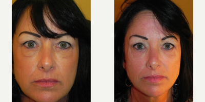 Restylane before and after photo