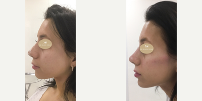 Voluma before and after photo