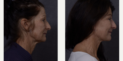 Eyelid Surgery before and after photo