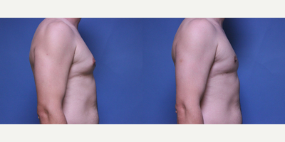 Gynecomastia Surgery before and after photo