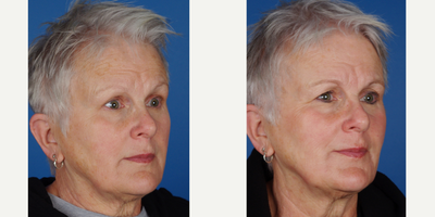 Laser Peel before and after photo