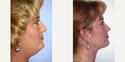 Liposuction before and after photo