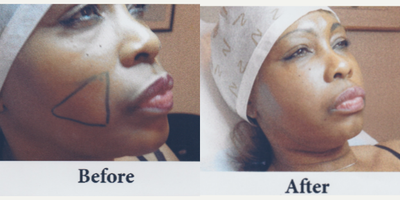 Nonsurgical Facelift before and after photo