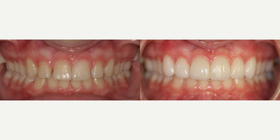 Porcelain Veneers before and after photo
