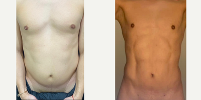 Abdominal Etching before and after photo