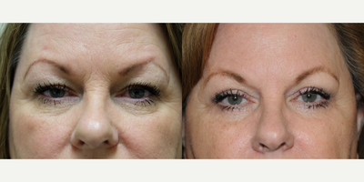 Eyelid Surgery before and after photo