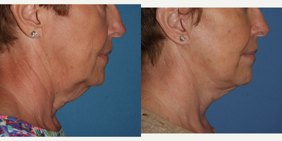 Facelift before and after photo