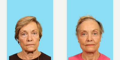 Facelift before and after photo