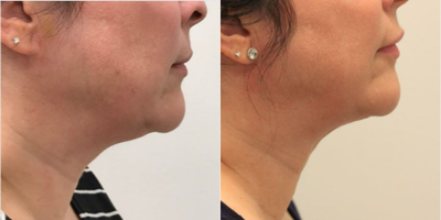 FaceTite before and after photo