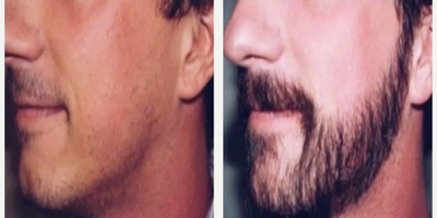 Hair Transplant before and after photo