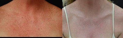 IPL before and after photo