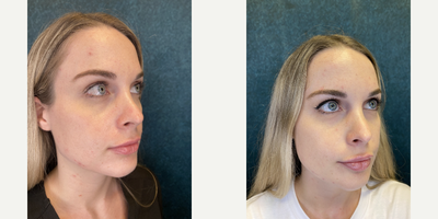 Lip Fillers before and after photo