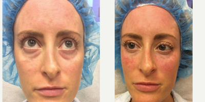 Restylane before and after photo