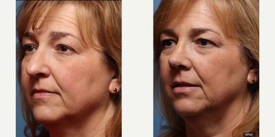 Rhinoplasty before and after photo