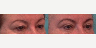 Eyelid Surgery before and after photo