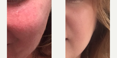 IPL before and after photo
