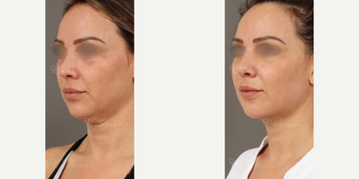 Neck Lift before and after photo