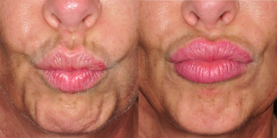 Botox before and after photo