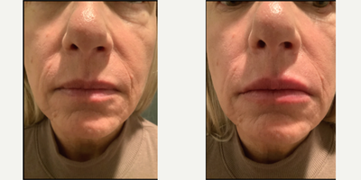 Dermal Fillers before and after photo