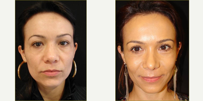Eyelid Surgery before and after photo