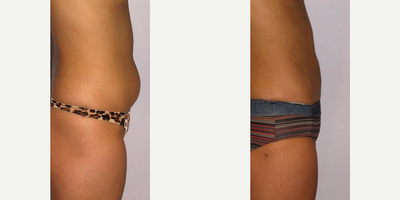 Liposuction before and after photo