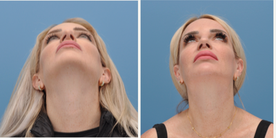 Revision Rhinoplasty before and after photo