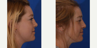 Rhinoplasty before and after photo