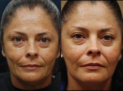 Sculptra before and after photo